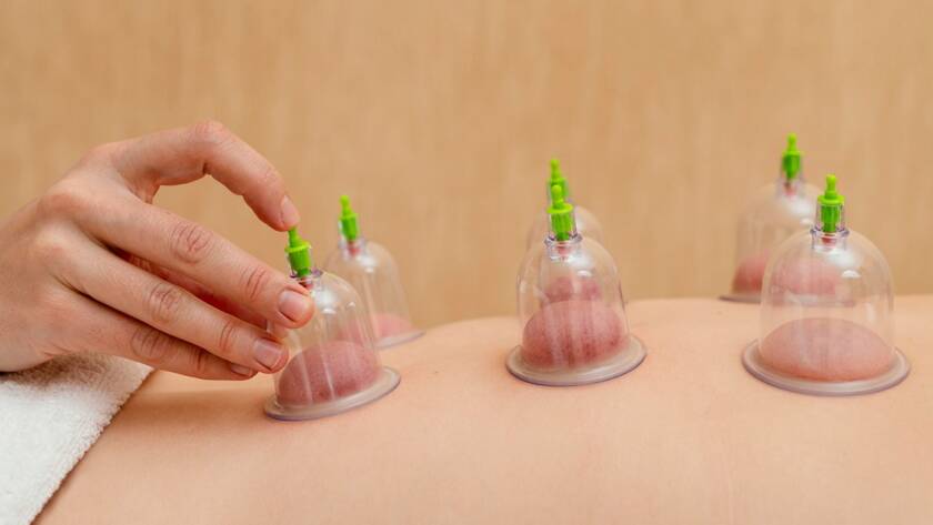 Cupping Massage therapy Calabasas